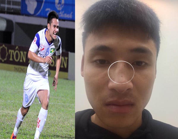 
Cầu thủ Lê Trung Hiếu của Đắk Lắk đã chia sẻ hình ảnh chiếc mũi bị một đồng nghiệp SL Nghệ An đấm gãy
