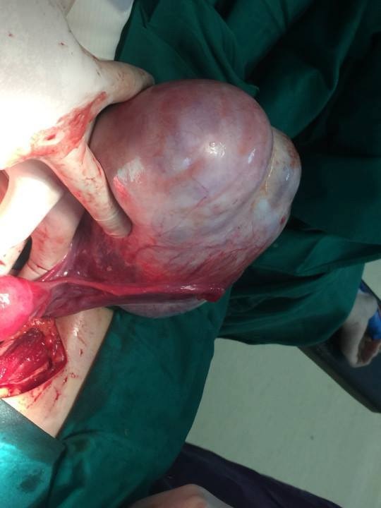 Cô gái mang khối u gần 2kg lại ngỡ do béo phì - 1 Khối u nhầy buồng trứng khổng lồ được các bác sĩ lấy ra thành công. Ảnh: BS cung cấp.