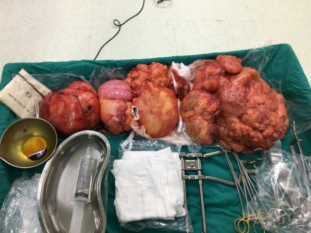 Khối u nặng 10kg chèn ép hết ổ bụng bệnh nhân X.