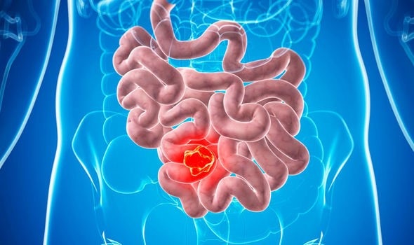 
Có thể điều trị ung thư ruột bằng một loại thuốc mới.

