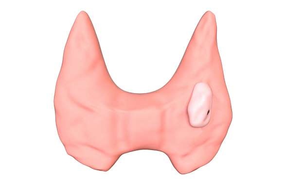 4 dấu hiệu ung thư tuyến giáp cần để ý - 4