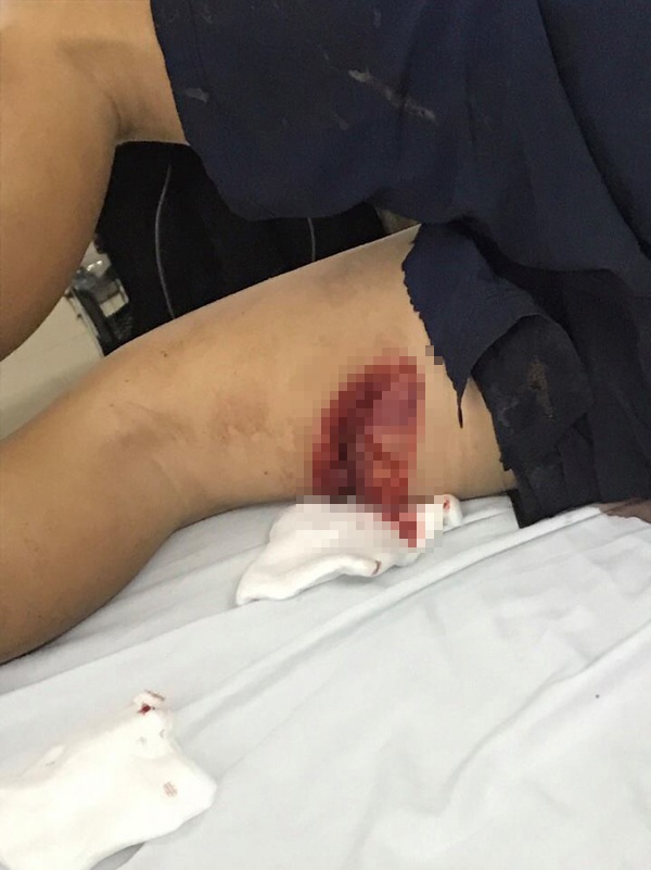 Nam thanh niên gục ngã trước lưỡi kiếm truy sát của nhóm côn đồ bịt mặt - 2
Nạn nhận bị chém hàng chục vết thương trên cơ thể