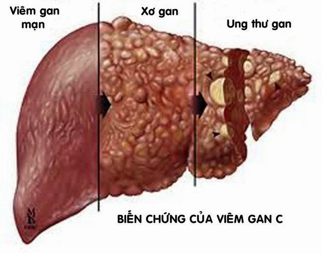 Việt Nam đạt được thoả thuận về thuốc chữa viêm gan C giá rẻ - 1