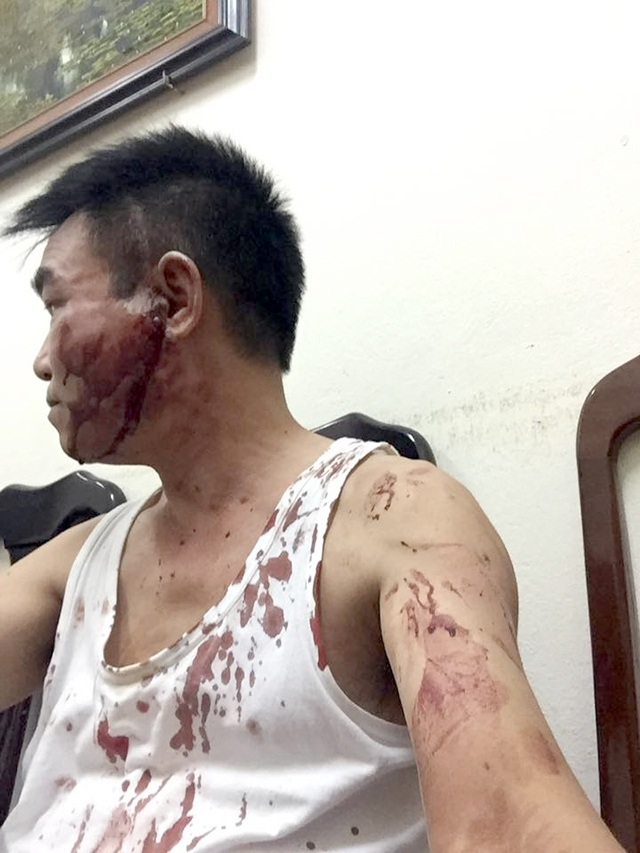 Hà Nội: Cán bộ thanh tra xây dựng đánh anh trai nhập viện - 1 Sau khi bị đánh, người ông Lê Văn Hải bê bết máu