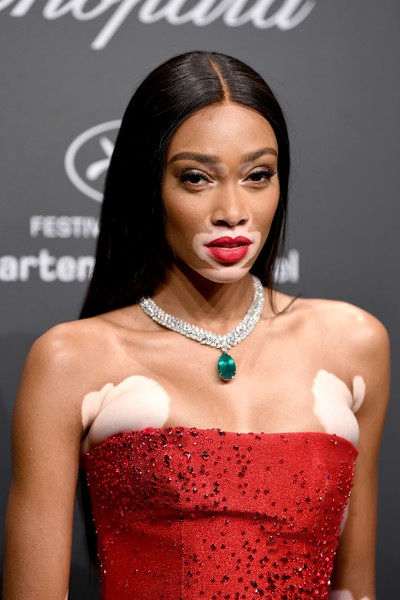 Người mẫu bạch biến nổi bật trong tiệc tại Cannes - 4
Winnie Harlow là trường hợp hiếm hoi trong làng mốt - bị bạch biến vẫn đắt show và nổi tiếng