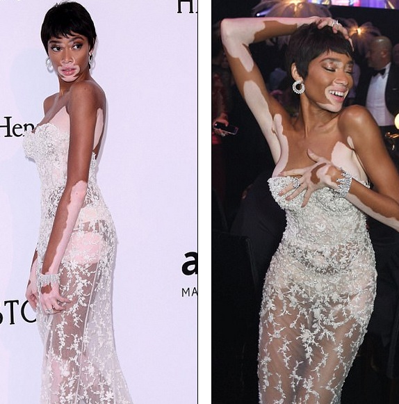 "Chân dài" bạch biến tự tin diện váy xuyên thấu - 3
Winnie Harlow là trường hợp dị biệt trong làng thời trang khi mắc bệnh bạch biến mà vẫn nổi tiếng
