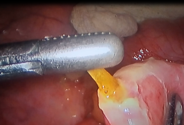 Mục sở thị quá trình lấy xương cá dài 4cm đâm thủng ruột non - 1 Xương cá đâm thủng ruột non của bệnh nhân T.
