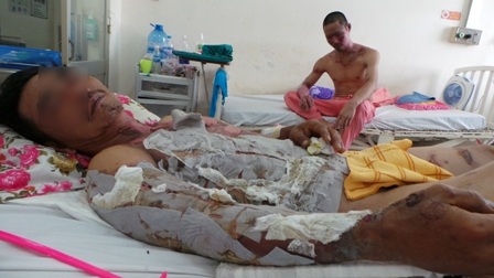 Vào bếp nấu cơm, 2 người bị bỏng ga nặng - 1 Bỏng lửa gas là tai nạn nguy hiểm, người dân cần chủ động phòng tránh