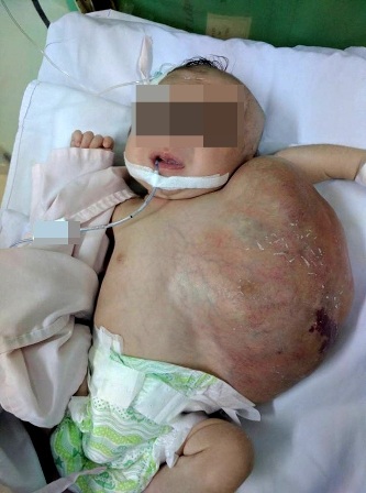 Bé gái chào đời mang theo “bướu quỷ” trên cổ - 1 Khối bướu lớn, phát triển nhanh sau khi bệnh nhi chào đời