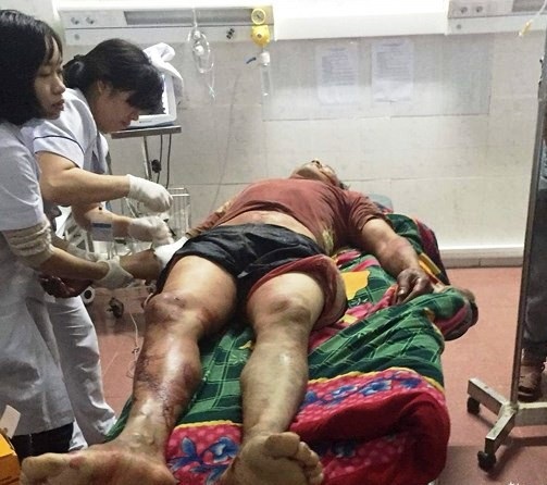 Mâu thuẫn tiền làm công, người đàn ông bị chém trọng thương - 1 Anh Hoàng bị chém nhiều nhát và phải nhập viện cấp cứu.