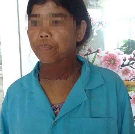 Cắt bỏ thành công bướu giáp "khủng" 2,5kg - 2 Và sau mổ