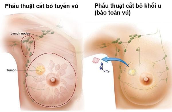 Thường xuyên nóng đầu ngực, đi khám mới phát hiện ung thư vú - 2 Hơn 92% ung thư vú có thể chữa khỏi nếu phát hiện sớm