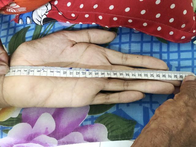 Người đàn ông cao hơn 2m ở Cà Mau không muốn kỷ lục, chỉ mong có tiền trị bệnh - 3 Người đàn ông cao hơn 2m ở Cà Mau không muốn kỷ lục, chỉ mong có tiền trị bệnh - 3