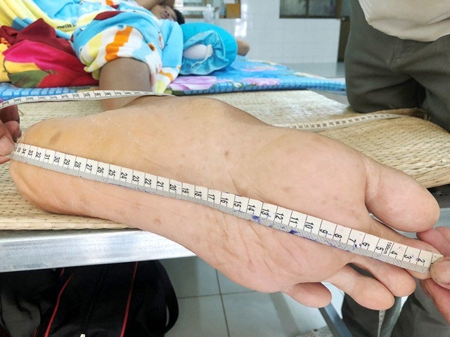 Người đàn ông cao hơn 2m ở Cà Mau không muốn kỷ lục, chỉ mong có tiền trị bệnh - 4 Với thân hình quá khổ, bàn tay, chân của anh Trung cũng to hơn bình thường. Gia đình đã phải thuê người làm chiếc giường riêng để anh Trung nằm trị bệnh.