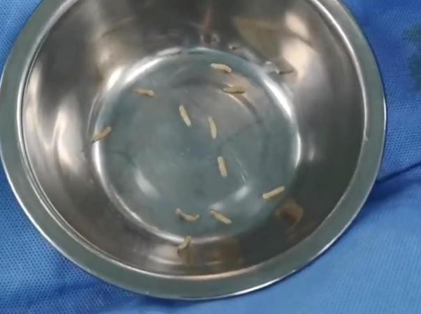 Bắt hơn 50 con giòi từ vết thương mưng mủ của cụ bà 97 tuổi - 2 Các bác sĩ đã loại bỏ hơn 50 con giòi từ má bà cụ