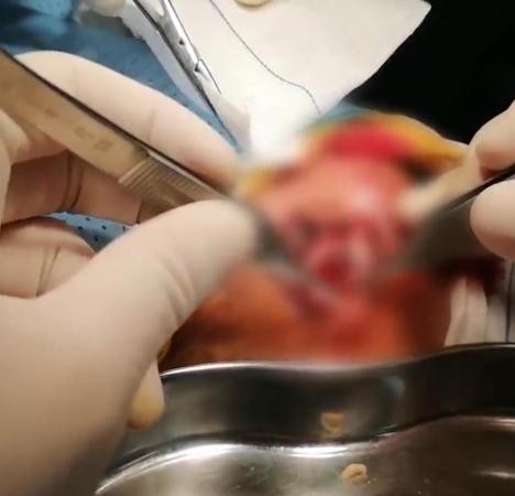 Bắt hơn 50 con giòi từ vết thương mưng mủ của cụ bà 97 tuổi - 4 Nhiều bác sĩ đã cùng nhau tiến hành loại bỏ ký sinh trùng ra khỏi vết thương của cụ bà