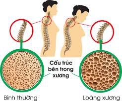 Canxi, vitamin D và tập luyện làm giảm nguy cơ loãng xương - 1 Canxi, vitamin D và tập luyện làm giảm nguy cơ loãng xương - 1