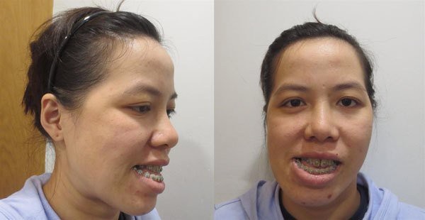 Cô giáo mặt méo ‘lột xác’ ngoạn mục sau phẫu thuật thẩm mỹ - 1