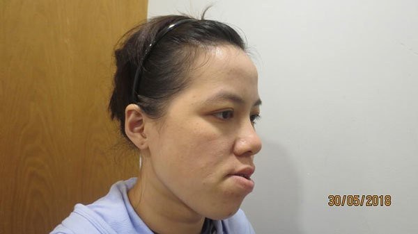 Cô giáo mặt méo ‘lột xác’ ngoạn mục sau phẫu thuật thẩm mỹ - 2