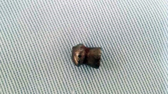 Nam thanh niên bất ngờ bị trúng đạn khi đang làm vườn - 1 Viên đạn chì được các bác sỹ gắp ra từ người anh K.