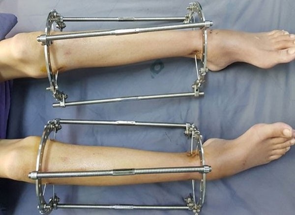 Nắn chỉnh, kéo dài chân làm đẹp coi chừng tai biến - 1
Phẫu thuật kéo chân chịu rất nhiều đau đớn