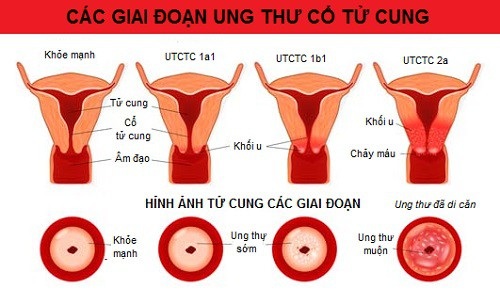  Cổ tử cung trơn láng và tác động đến sức khỏe sinh sản