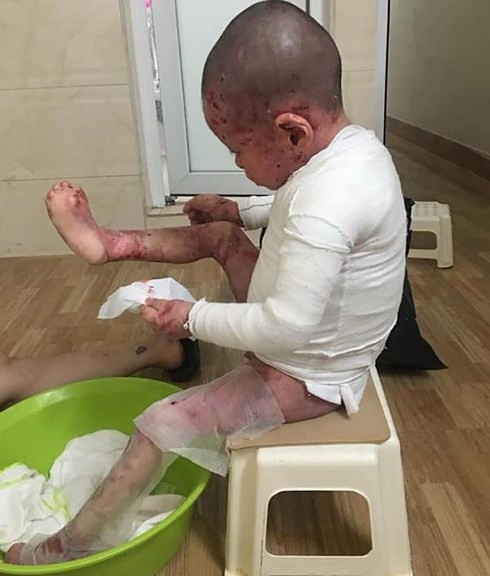 Những trẻ bị bệnh EB sống nhờ vào băng bông và thuốc men. (Ảnh: NVCC)