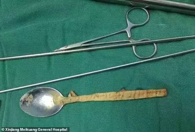 Sốc người đàn ông nuốt thìa suốt một năm không thèm đi bác sĩ - 2 Bác sĩ mất 2 tiếng để lấy chiếc thìa ra