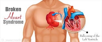 Hội chứng "trái tim vỡ": Tổn thương tim do stress - 1 Hội chứng "trái tim vỡ": Tổn thương tim do stress - 1