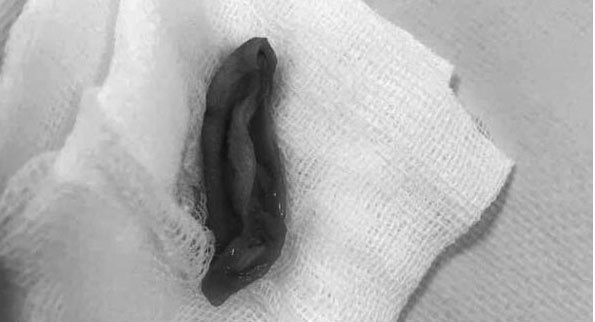 
Vành tai của bệnh nhi T được gắp ra từ dạ dày của bạn
