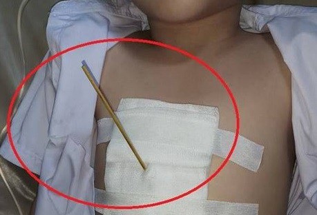 Vừa ăn cá viên chiên vừa chơi, bé 7 tuổi bị que xiên đâm thấu ngực - 1 Cây xiên cá viên đâm vào lồng ngực bệnh nhi (ảnh: bệnh viện cung cấp)