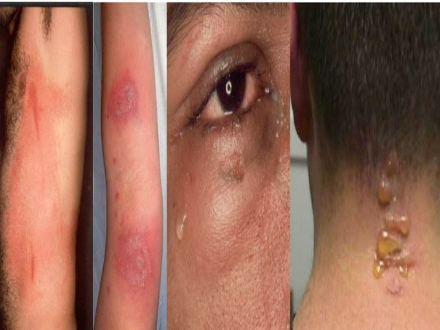 Vào mùa kiến ba khoang tăng vọt bệnh nhân đến khám vì viêm da tiếp xúc - 1 Các tổn thương điển hình do kiến ba khoang gây ra.