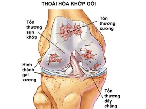 Thoái hóa khớp - Căn nguyên làm giảm chất lượng cuộc sống - 1 Thoái hóa khớp có thể dẫn đến tàn phế