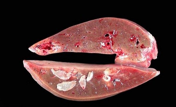 Tưởng mụn ở ngực, cô gái Sơn La nặn ra con sán ngoe nguẩy - 2 Sán lá gan lớn gây tổn thương gan