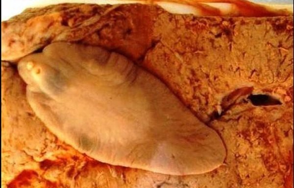 Tưởng mụn ở ngực, cô gái Sơn La nặn ra con sán ngoe nguẩy - 3 Cận cảnh sán lá gan lớn