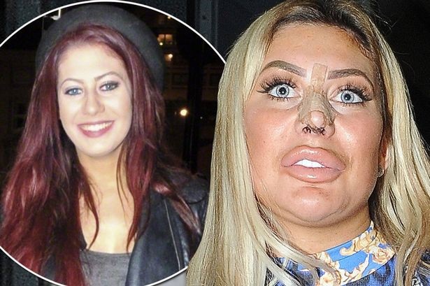 Gương mặt cứng đơ của sao "nghiện dao kéo" Chloe Ferry - 5
Chloe đã từng sửa mũi, hút mỡ, nâng ngực, độn mông... thời gian qua