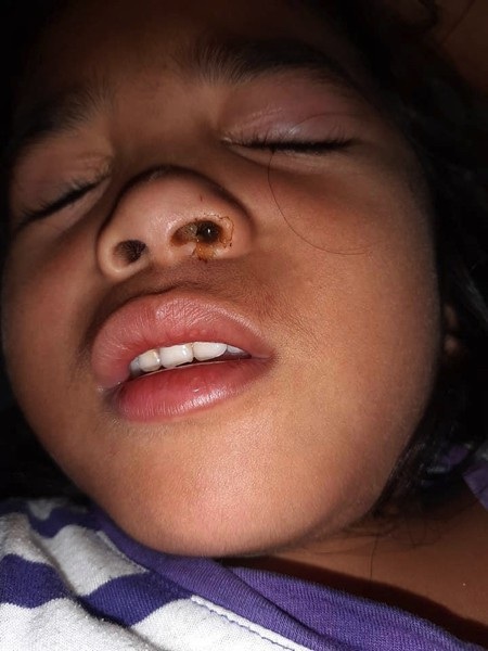 Bé 5 tuổi chịu đau đớn vì pin kẹt trong lỗ mũi suốt 4 ngày - 1 Bé Scarlett Chavez vừa lâm vào tình cảnh hết sức đáng quan ngại