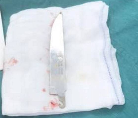 Cứu sống bệnh nhân bị dao găm dài hơn 11cm đâm thủng phổi - 2 Con dao được lấy ra khỏi người bệnh nhân.