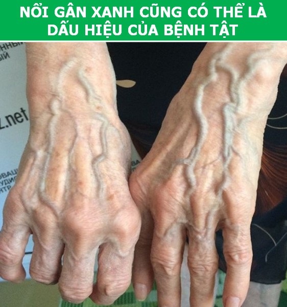 Tại sao cơ thể của bạn lại “nổi gân xanh” trong khi người khác lại không? - 4 Tại sao cơ thể của bạn lại “nổi gân xanh” trong khi người khác lại không? - 4
