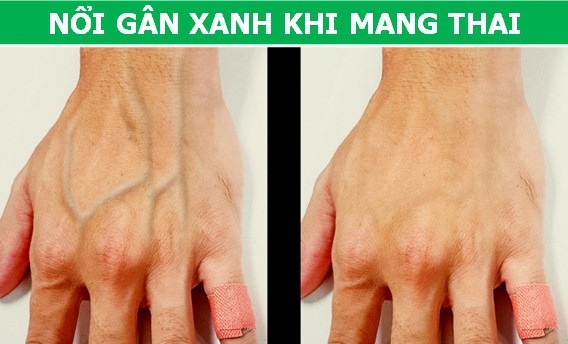 Tại sao cơ thể của bạn lại “nổi gân xanh” trong khi người khác lại không? - 3 Tại sao cơ thể của bạn lại “nổi gân xanh” trong khi người khác lại không? - 3