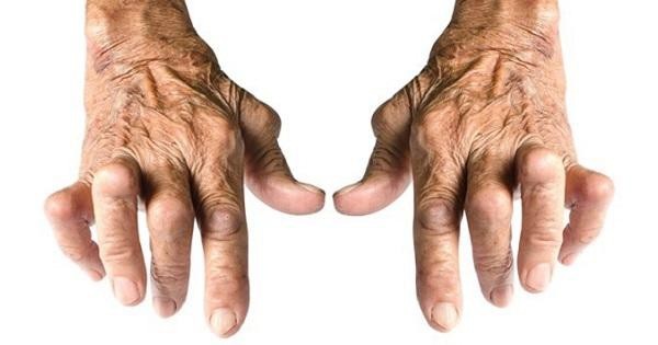 Chân tay sưng phồng: Dấu hiệu viêm khớp dạng thấp đã “ghé thăm” - 1 Nhận biết viêm khớp dạng thấp qua biểu hiện chân tay sưng phồng