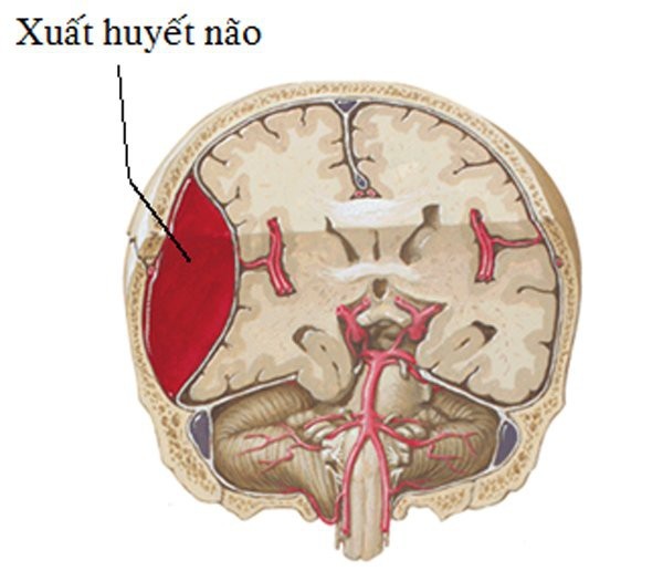 Không rượu bia, thuốc lá, kỹ sư 48 tuổi bất ngờ xuất huyết não do tham công tiếc việc - 2 Không rượu bia, thuốc lá, kỹ sư 48 tuổi bất ngờ xuất huyết não do tham công tiếc việc - 2