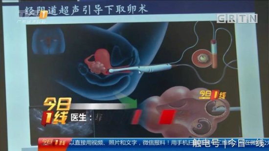 Phẫu thuật lấy trứng cần đến bác sĩ có tay nghề. Để rơi vào tay những kẻ mua bán chui rất có thể nguy hiểm đến tính mạng.