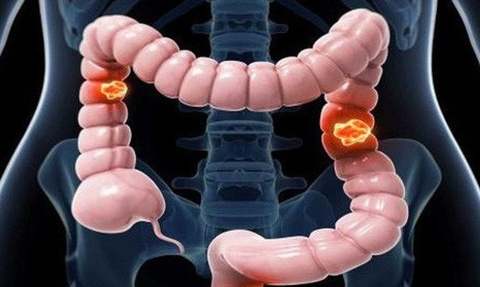 Cảnh báo nguy cơ mắc ung thư từ bệnh viêm đại tràng - 1 Ung thư đại tràng đe dọa tính mạng nhiều người