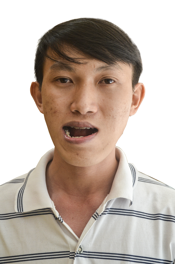 Chàng cử nhân “mặt quỷ” cắt 2 hàm trở thành “hot boy” - 1
Duy Phương mang gương mặt biến dạng, méo mó trước khi phẫu thuật