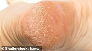 Tiết lộ không ngờ về sức khỏe qua dấu hiệu ở 2 bàn chân - 4
Da khô liên tục, mặc dù giữ ẩm, có thể là dấu hiệu của tăng sừng hóa, mà người già có nguy cơ cao hơn