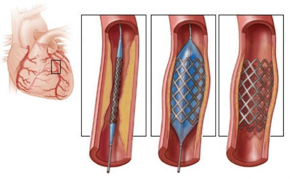 Đặt stent mạch vành - Những rủi ro người bệnh cần biết - 1 Hình ảnh của thông tim, nong bóng đặt stent mạch vành qua da