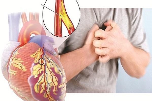 Đặt stent mạch vành - Những rủi ro người bệnh cần biết - 2 Người bệnh cần phải đặt stent khi mạch vành tắc hẹp nặng