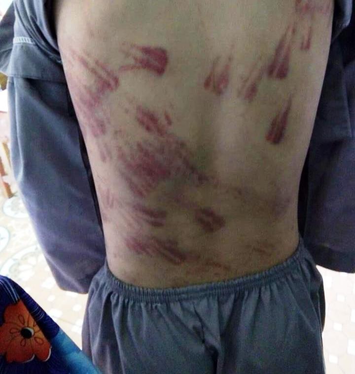 Cháu bé mồ côi bị sư thầy đánh bầm tím khắp cơ thể - Ảnh 2. Cháu bé mồ côi bị sư thầy đánh bầm tím khắp cơ thể - Ảnh 2.