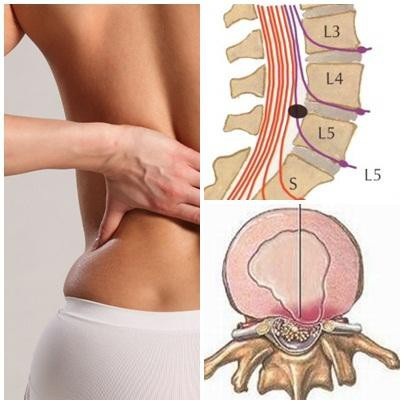 Nguy cơ liệt nửa người nếu coi thường thoát vị đĩa đệm cột sống thắt lưng L5 - S1 - 1 Thoát vị đĩa đệm thắt lưng L5 - S1